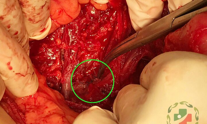 Mắc bệnh hoang tưởng, chồng dùng mũi tên xiên cá đâm vợ