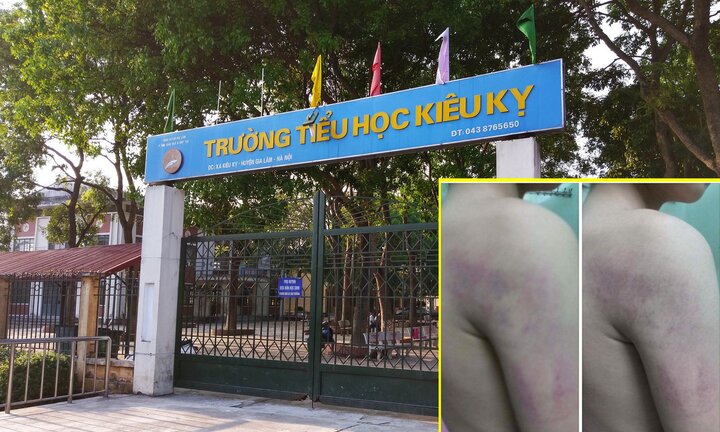 Kỷ luật cảnh cáo cô giáo đánh bầm tím người học sinh lớp 1 ở Hà Nội