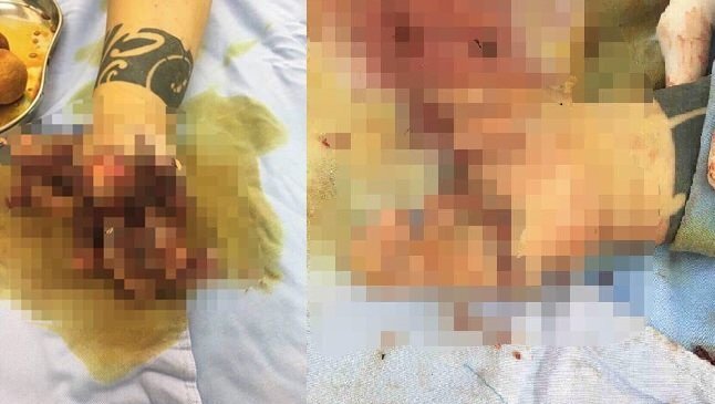 Cầm chơi 'lựu đạn giả', người phụ nữ bị dập nát bàn tay