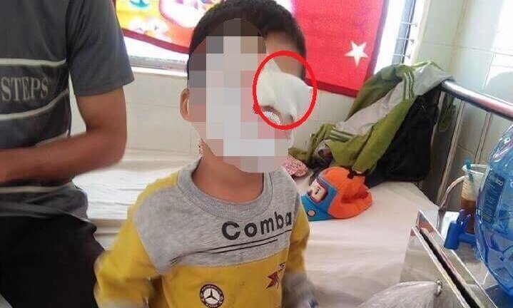 Bé trai bị bạn bắn bút chì trúng mắt: Phòng GD-ĐT sẽ xử lý nghiêm giáo viên