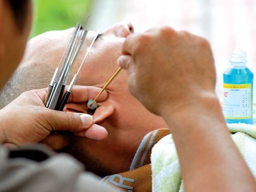 Sơ ý khi ngoáy tai, cục bông bị kẹt bên trong suốt 2 năm