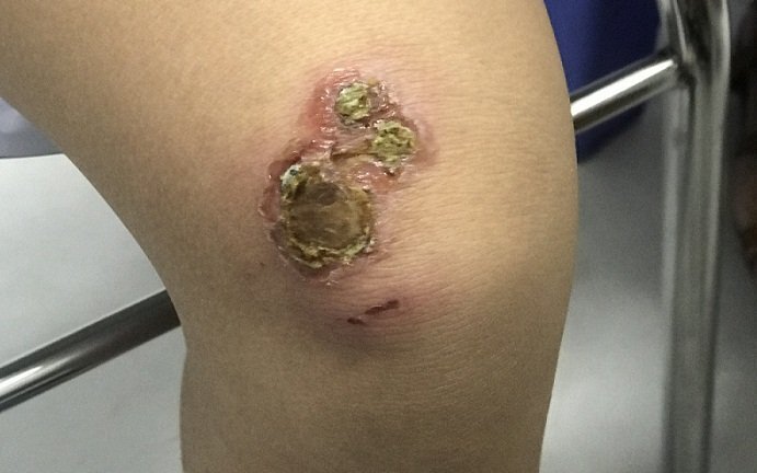 Cảnh giác con bạn dễ nhiễm trùng da, lở loét hơn trong mùa hè