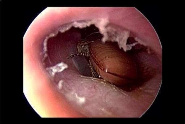 Video: Rùng mình cảnh gắp con gián chết thối rữa ra khỏi lỗ tai người phụ nữ