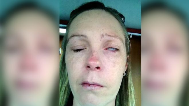 Bị bọ ve trong vườn cắn, người phụ nữ bị liệt nửa mặt, không thể nói và không thể nhắm mắt