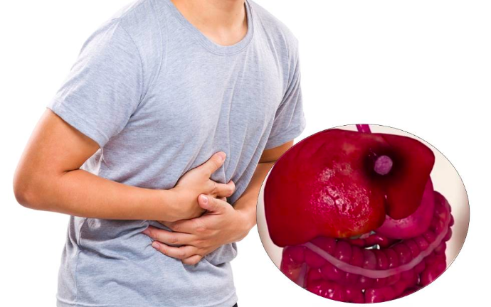 Ăn bún, phở, dưa chua, thực phẩm bị mốc có thể khiến bạn mắc ung thư gì?