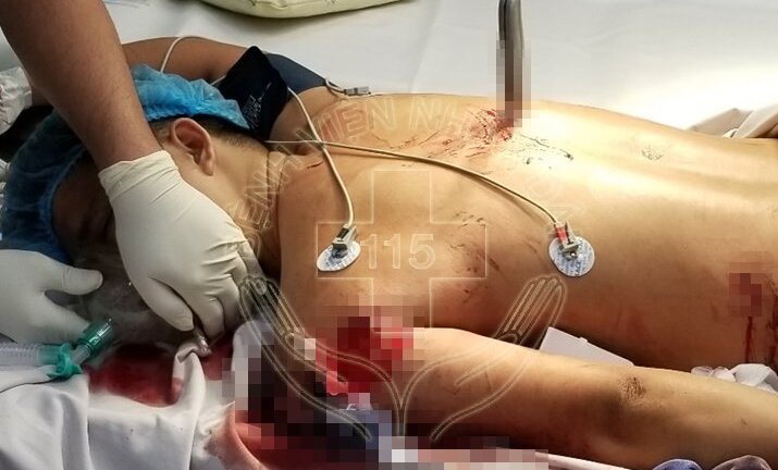 Bệnh viện bật 'báo động đỏ' cứu người đàn ông bị dao đâm xuyên ngực