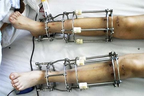 Kéo dài chân 4,2 cm, chàng trai Cà Mau lần đầu đi được thăng bằng