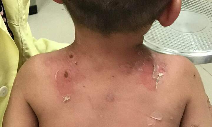 Lại tin lá rừng, bé trai 2 tuổi nổi mụn lở loét, trợt da khắp người