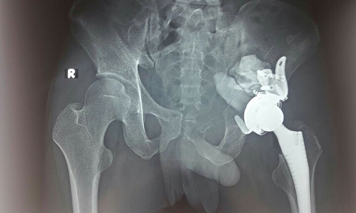 Bị khối u khổng lồ chiếm khớp háng, đâm vào ổ bụng, chàng trai phải chống nạng đến bệnh viện điều trị