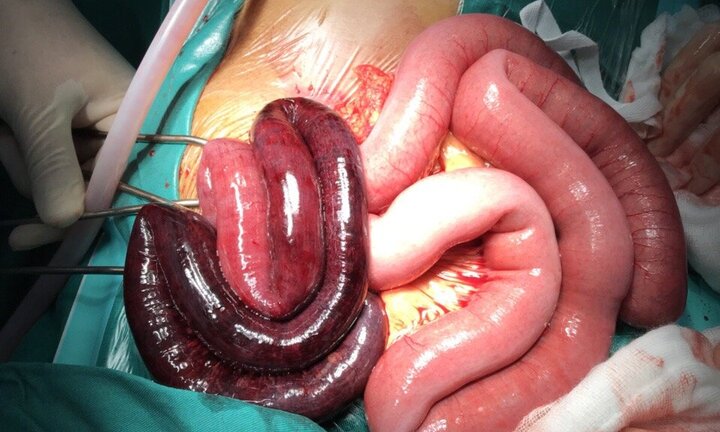 2 ngày không đi đại tiện, cụ ông bị hoại tử 1 m ruột