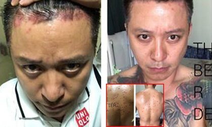 Căn bệnh khiến ca sỹ Tuấn Hưng 'phát điên' khó chữa tới mức nào?