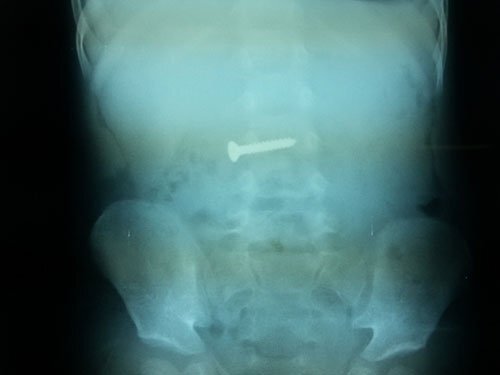 Cấp cứu gắp ốc vít trong bụng bé 2 tuổi ở Nghệ An