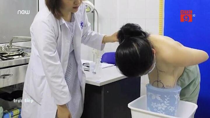 Video: Ngực to gấp 6 lần bình thường, nữ bệnh nhân được phẫu thuật thu gọn vú