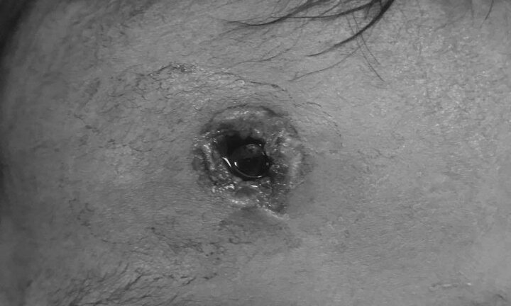 Cháu nghịch súng tự chế của cậu, bé trai 33 tháng tuổi bị đạn bắn vào trán