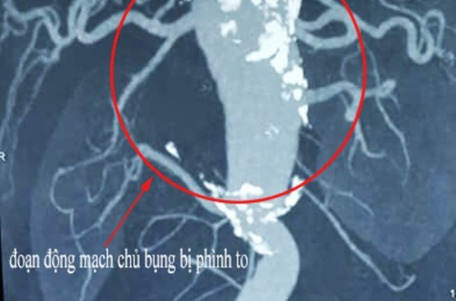 Cứu người đàn ông bị phình động mạch chủ bụng 60 cm ở vị trí 'độc'