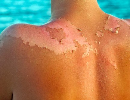 Tại sao da lại bong tróc khi bị 'tra tấn' cả ngày dưới nắng?