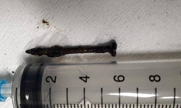 Bị cây đinh gỉ sét văng vào phổi, người đàn ông nghèo nhịn đến bệnh viện suốt 4 tháng