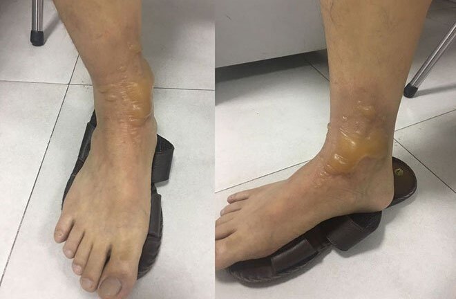 Đi massage chân, người đàn ông ở Hà Nội bị bỏng nặng