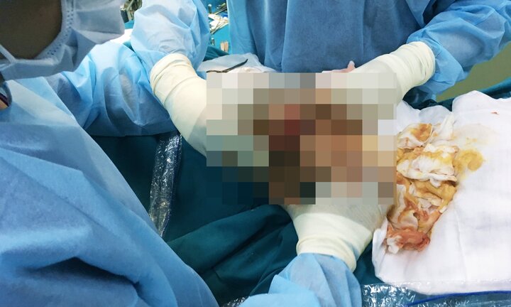 Một nữ Việt kiều biến dạng ngực nặng nề sau 3 năm bơm chất lạ vào người