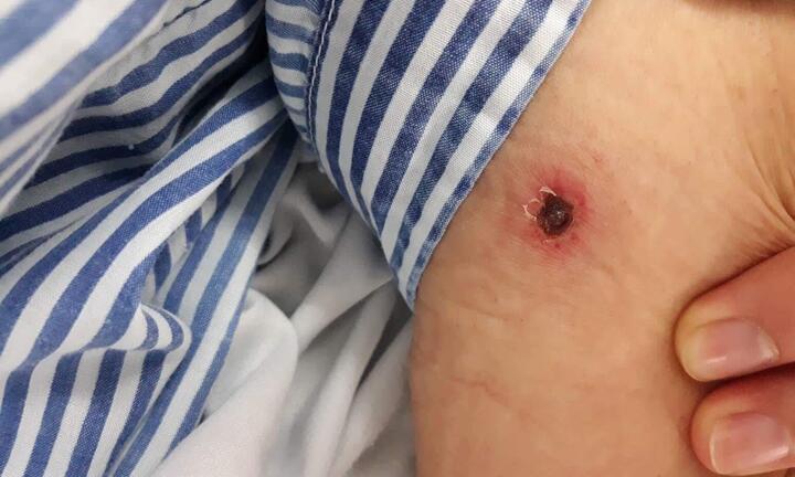 Từ một vết bọ đốt ở tay, người phụ nữ suýt mất mạng