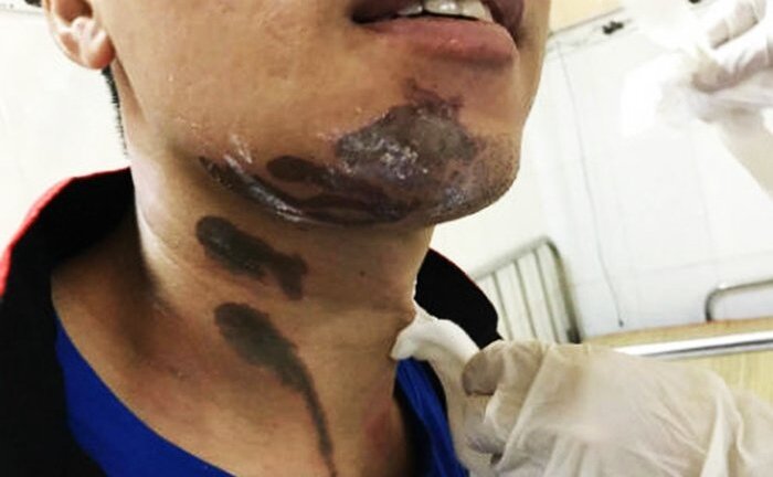 Người đàn ông bị bỏng vì bột thông hầm cầu văng lên người