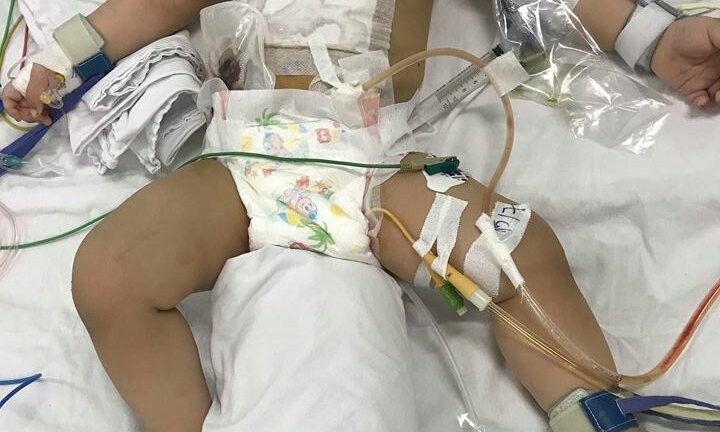 Cứu sống bé trai có 8 lỗ thủng ở ruột