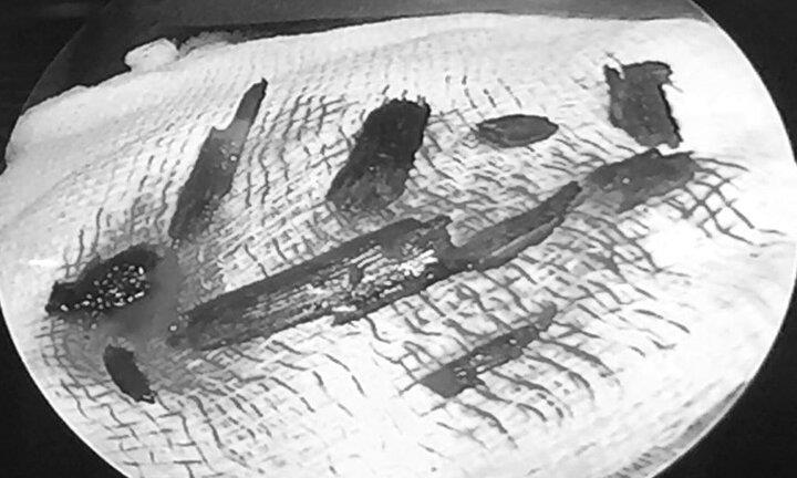 Ngã xe đập mặt xuống đường, người đàn ông bị 10 mảnh gỗ găm vào hốc mắt