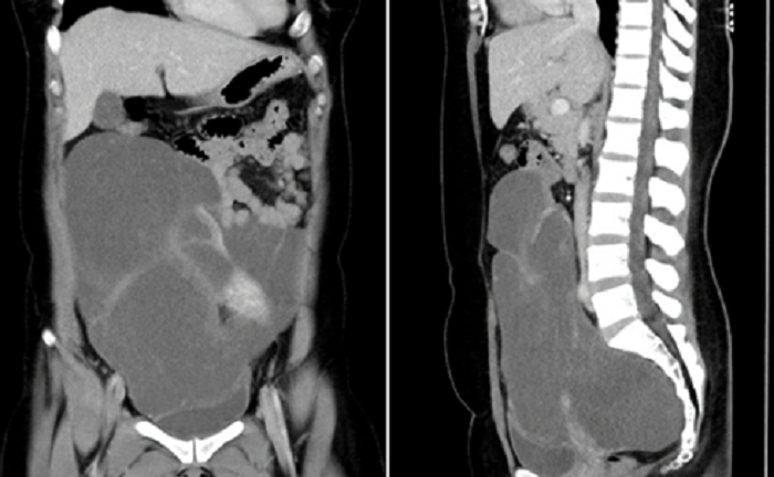 Người phụ nữ 35 tuổi mang khối u 2,8kg hiếm gặp