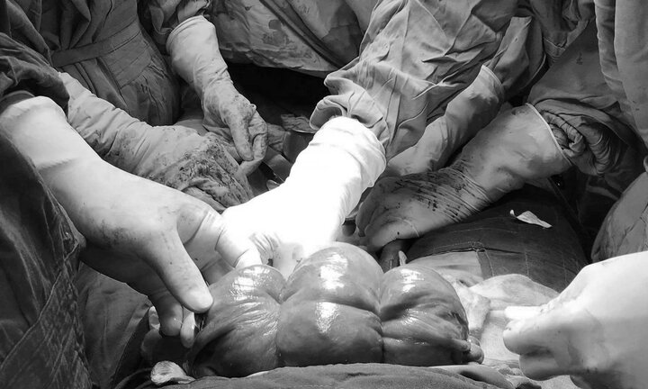 Giữ lại chức năng làm mẹ cho sản phụ băng huyết sau sinh bằng mũi khâu đặc biệt