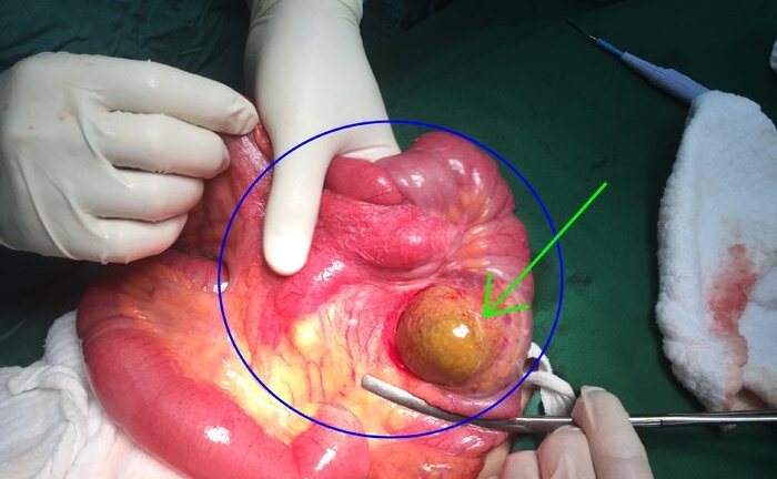 Bệnh nhân bị lồng ruột do khối u ruột non gây ra được cứu