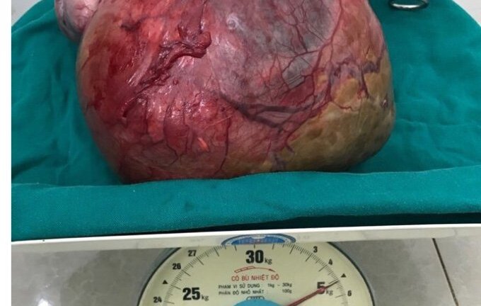 Bệnh viện Đa khoa Đồng Văn - Hà Giang phẫu thuật thành công u nang nặng 5kg