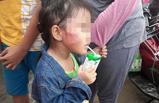 Cô giáo tát bé gái 5 tuổi sưng mặt ở TP.HCM: Gia đình quyết định thế nào?