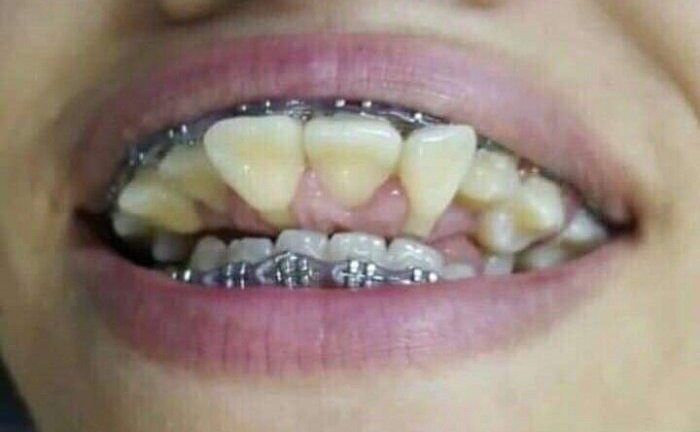 Phát hoảng với cô gái sở hữu hàm răng chĩa ngược, 'chọc' vào mắt người nhìn