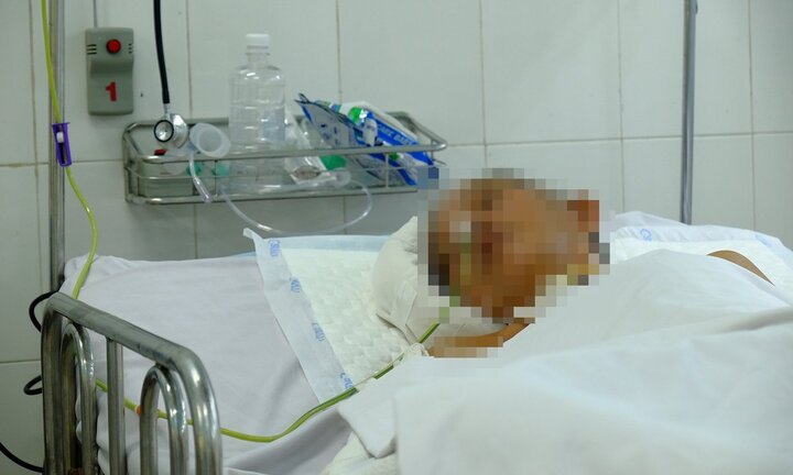 Vợ dùng dầu hôi đốt chồng bỏng da toàn thân