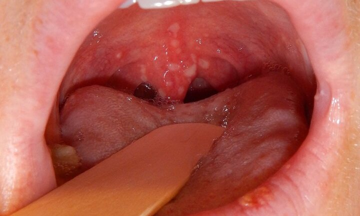 Cảnh báo những người dễ mắc và chết vì ung thư vòm họng