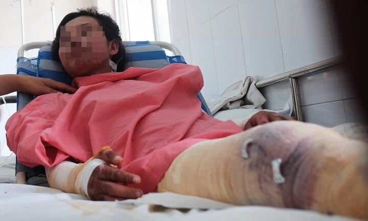 Bình gas mini phát nổ, nữ công nhân 18 tuổi bị bỏng nặng