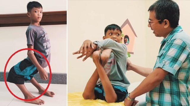 Mắc chứng bệnh quái ác, cậu bé có khớp chân bẻ ngược như chim hồng hạc