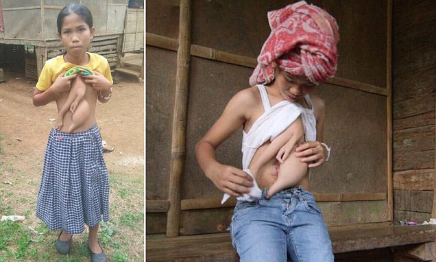 Xót xa cô bé 14 tuổi mang trên mình một phần cơ thể của chị em song sinh