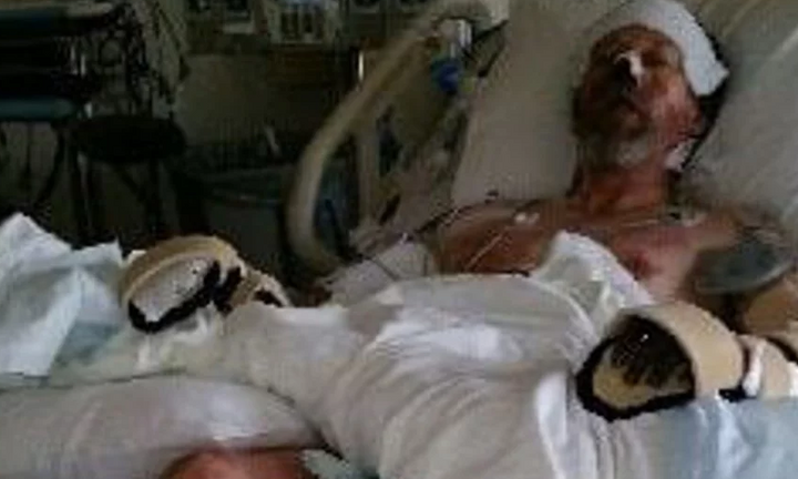 Bị chó liếm, người đàn ông phải cưa cả chân và tay