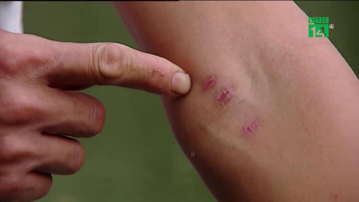 Xót xa người dân Chương Mỹ gần 1 tuần không tắm, ghẻ lở khắp người