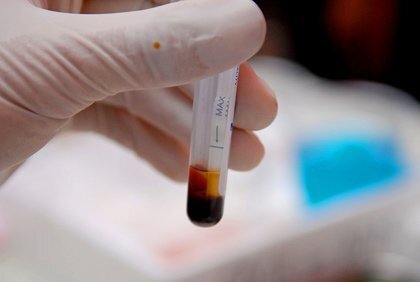 Xét nghiệm 1 giọt máu có thể chẩn đoán các bệnh viêm khớp trước 2 năm