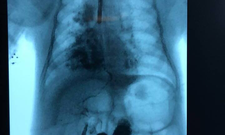 Bé gái 2 tháng tuổi mắc bệnh lạ chỉ 40 người trên thế giới gặp phải