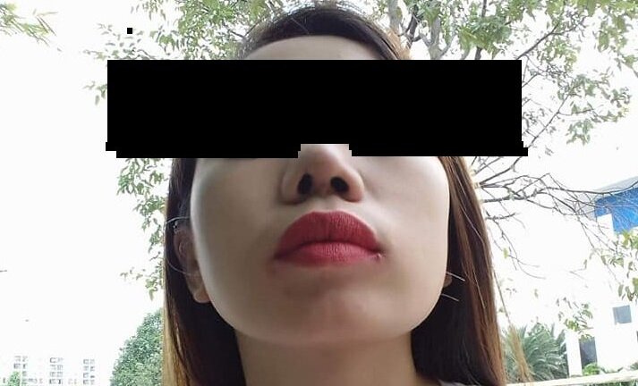 Bỏ 30 triệu đồng phẫu thuật thẩm mỹ, cô gái đau đớn bị lệch mũi