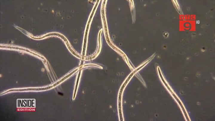 Nghịch cát khi đi tắm biển, hãi hùng bị giun móc xâm nhập khắp cơ thể