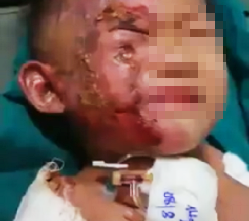 Ngã vào đống rác còn cháy, bé trai 4 tuổi bỏng nặng