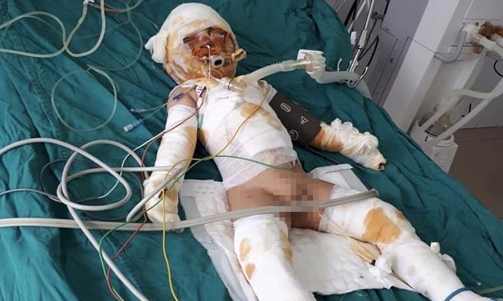 Thảm cảnh gia đình 3 người: Con hôn mê, mẹ bất tỉnh, bố bỏng tuột da chân do can xăng phát nổ