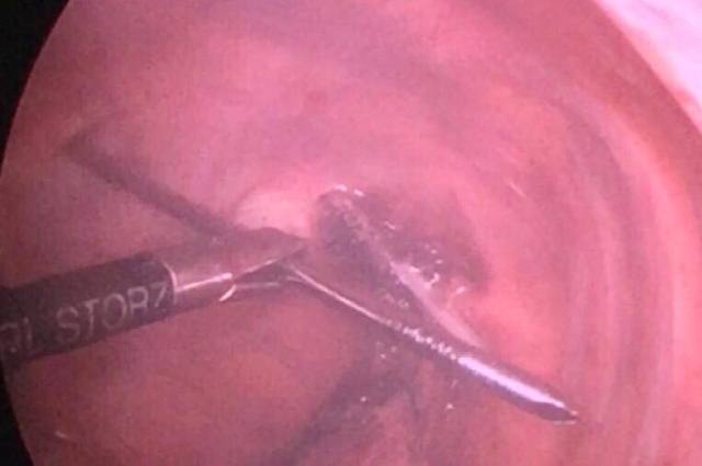 Người đàn ông bị chiếc đinh dài 12cm đâm qua phổi, xuyên qua tủy sống