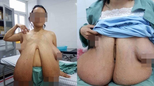 Sở hữu vòng 1 quá khổ, nhiều phụ nữ từng ngã sấp mặt
