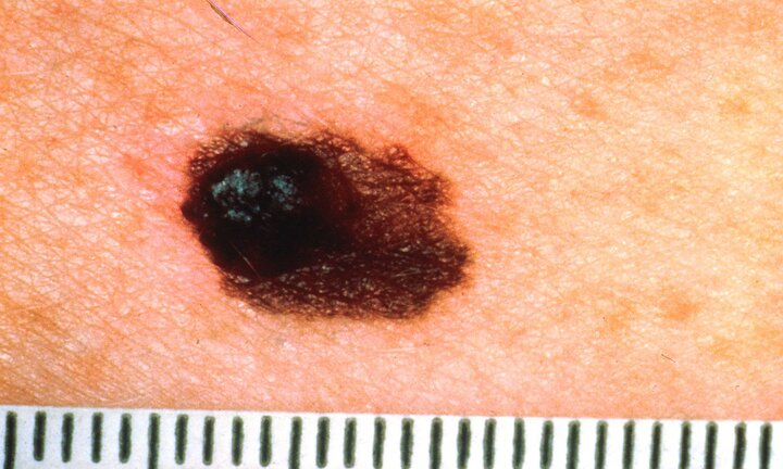 Vào bệnh viện tẩy đốt nốt ruồi, tá hỏa khi biết mình bị ung thư