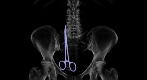 Bác sĩ để quên kéo dài 16cm trong cơ thể bệnh nhân suốt nửa năm